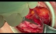 Reparación abierta de hernia inguinal