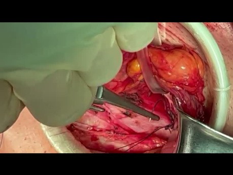 Reparación abierta de hernia inguinal