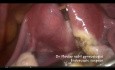 Poliomiomectomía laparoscópica estándar (miomas de tipo 6 y 7)