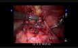  Liberación laparoscópica de adherencias peritoneales utilizando el robot DaVinci