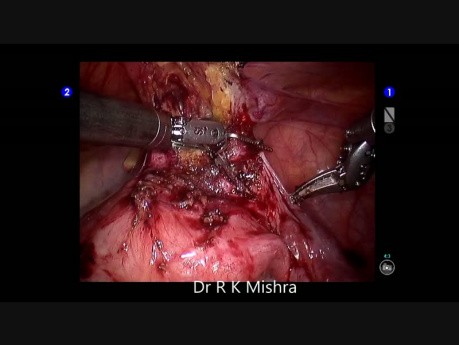  Liberación laparoscópica de adherencias peritoneales utilizando el robot DaVinci