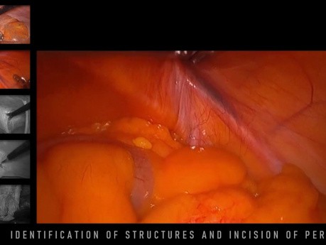 Operación de una hernia inguinal por el método TAPP