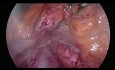 Arteria hepática reemplazada de AMS (tipo 5) durante pancreatoduodenectomía laparoscópica