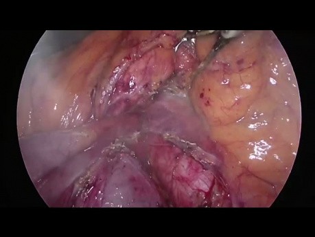 Arteria hepática reemplazada de AMS (tipo 5) durante pancreatoduodenectomía laparoscópica