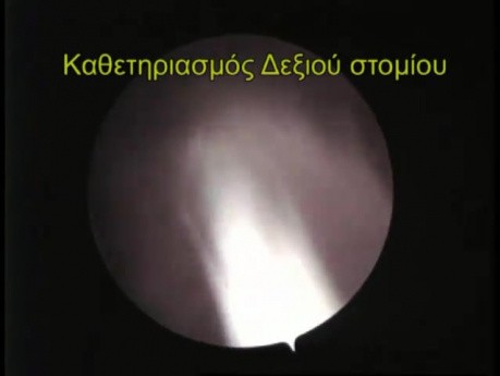 Estudio fluoroscópico retrógrado