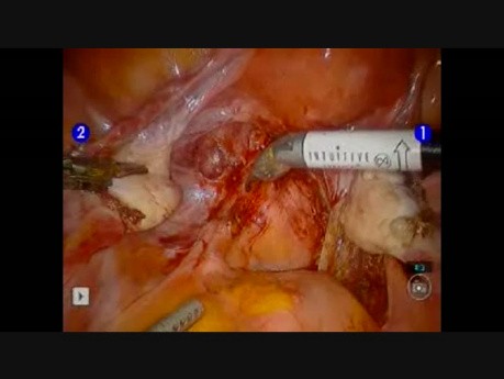 Escisión de endometriosis