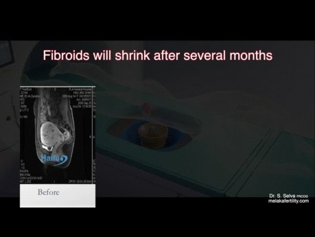 HIFU - Ultrasonido Focalizado de Alta Intensidad de fibromas