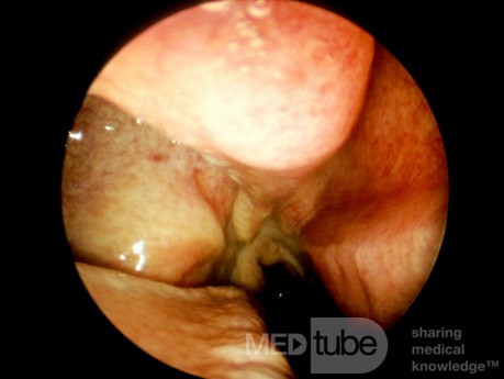 Hipoplasia del seno maxilar [tipo]