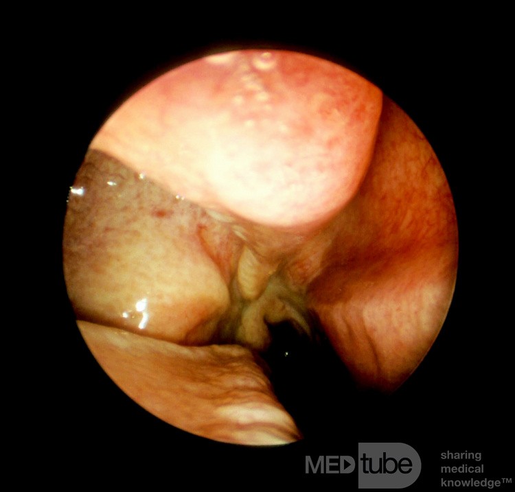 Hipoplasia del seno maxilar [tipo]