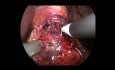 Miotomía de Heller laparoscópica y funduplicatura DOR para acalasia recurrente