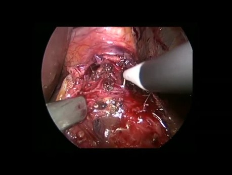 Miotomía de Heller laparoscópica y funduplicatura DOR para acalasia recurrente