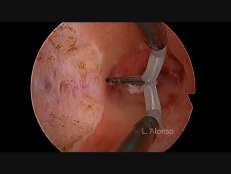 Estructura vascular del útero septado