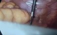 Reseccion anterior baja laparoscopica
