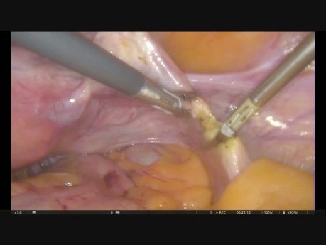 Histerectomía laparoscópica – hiperplasia endometrial con atipia