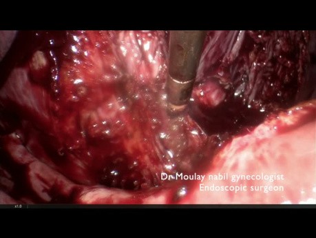 Acceso vascular difícil durante una polimiomectomía desafiante