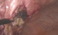 Tratamiento laparoscópico de la hernia umbilical