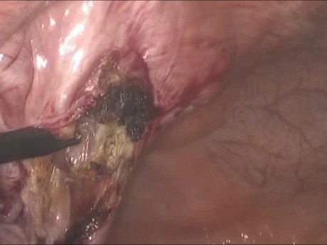 Tratamiento laparoscópico de la hernia umbilical