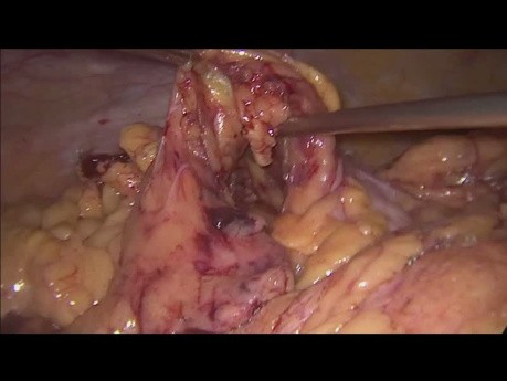 Hemicolectomía derecha laparoscópica con anastomosis intracorporal en un paciente con IMC 52