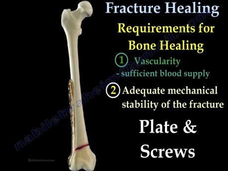 Curación de fracturas - video tutorial - Parte 1