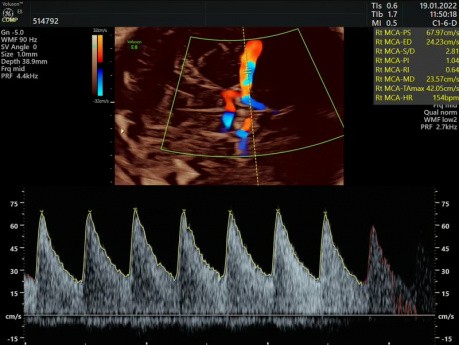 Doppler de la arteria cerebral media (ACM)