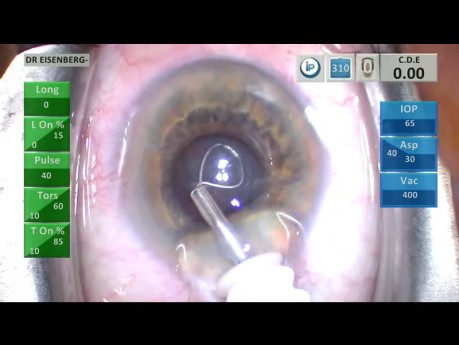Cirugía de cataratas en un ojo de 19 mm