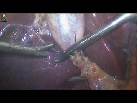 Control del conducto quístico con ligadura con sutura
