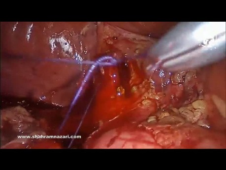 Tratamiento de la coledocolitiasis mediante exploración laparoscópica del tracto biliar después de una colangiopancreatografía retrógrada endoscópica fallida