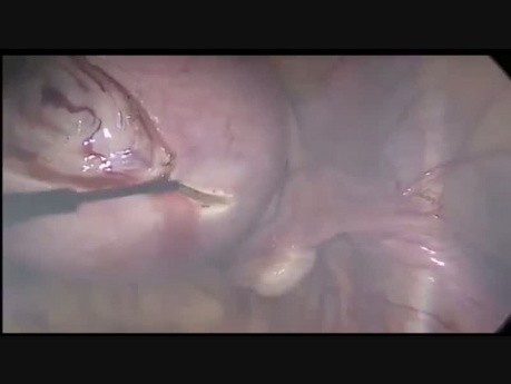 Miomectomía laparoscópica facilitada