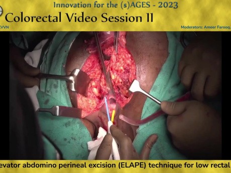 Técnica de escisión abdominoperineal con extraelevador (Elape) para el cáncer rectal bajo