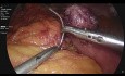 Mini Bypass Gástrico + Funduplicatura de Nissen + Reparación de Hernia de Hiato