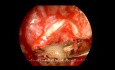Estapedotomía endoscópica para otosclerosis (microtaladro)