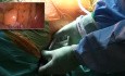 Microlobectomía con Flex Dex