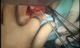 Fractura de húmero distal compleja en paciente pediátrica