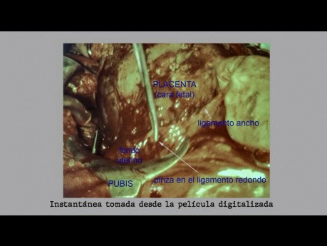 Embarazo Abdominal Termino Candido