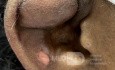 Hematoma auricular traumático