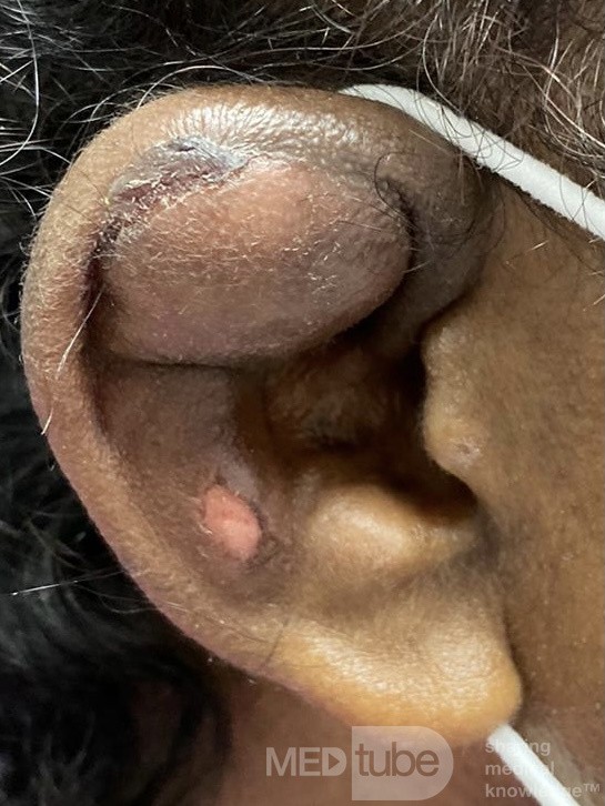 Hematoma auricular traumático