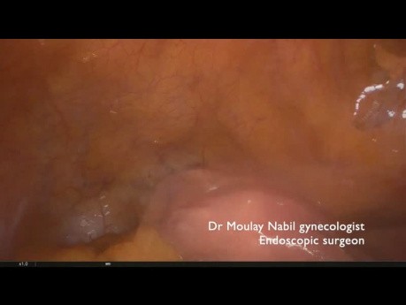 Necrosis anexial en la mujer posmenopáusica