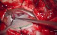 Descompresión microvascular para el espasmo hemifacial