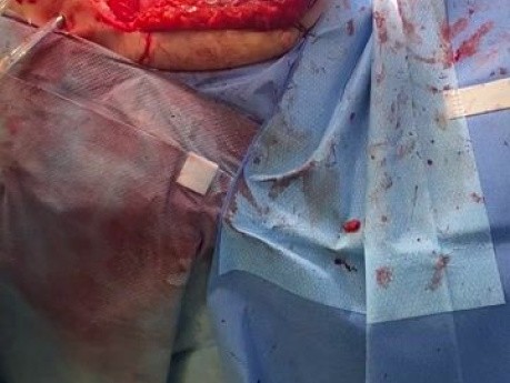 Trasplante pulmonar bilateral en paciente con EPI Cierre de tórax e inserción de drenaje