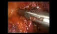 Hemicolectomía izquierda laparoscópica por cáncer