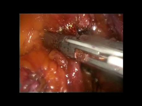 Hemicolectomía izquierda laparoscópica por cáncer