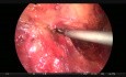 Resección anterior y hernia por vía laparoscópica 