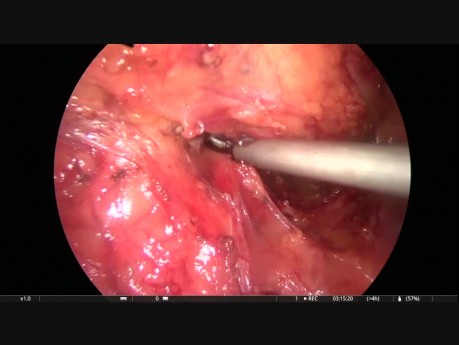 Resección anterior y hernia por vía laparoscópica 