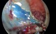 Disección submucosa transanal con TEO en un adenoma rectal grande. Alternativa segura para la ESD.