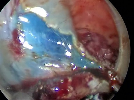 Disección submucosa transanal con TEO en un adenoma rectal grande. Alternativa segura para la ESD.