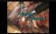 Nefrectomía izquierda laparoscópica