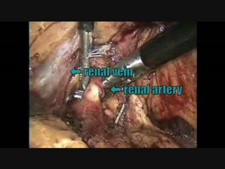 Nefrectomía izquierda laparoscópica