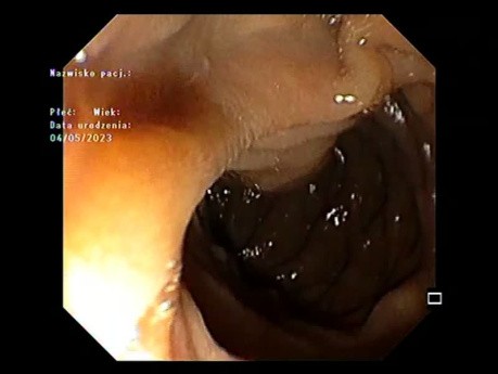 Ampolla de Vater en ojo de pez