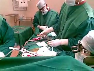 Cirugía de derivación de la arteria coronaria con el paciente despierto - CABG