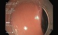 Resección submucosa endoscópica híbrida LST-G